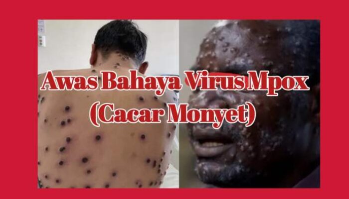 Waspada Virus Mpox / Cacar Monyet